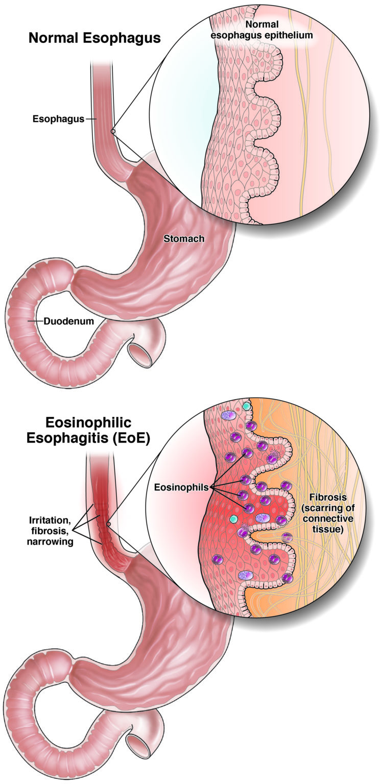 Eosinophilic Esophagitis Eoe Aga Gi Patient Center