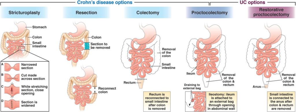 Crohn's Disease Treatment Options