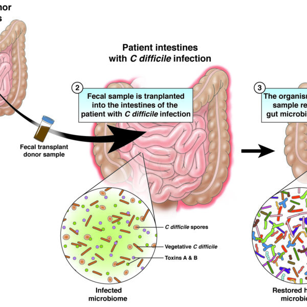 Fecal microbiota transplantation (FMT)