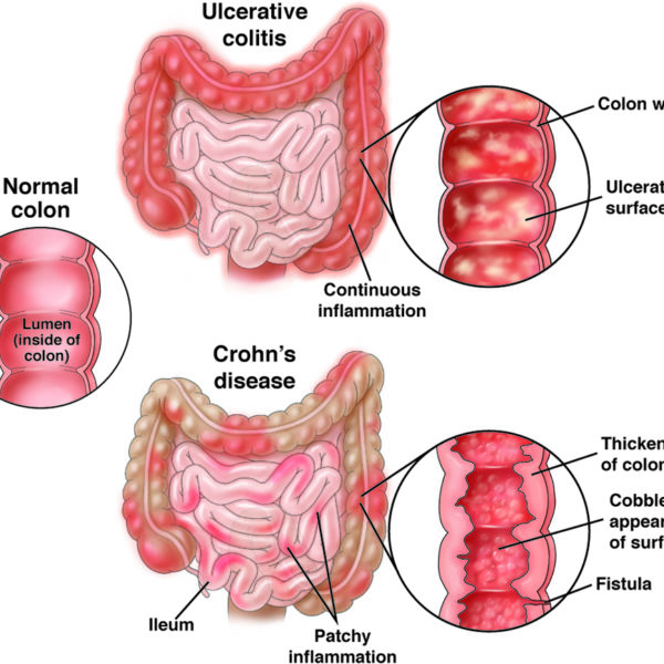 Ulcerative Colitis