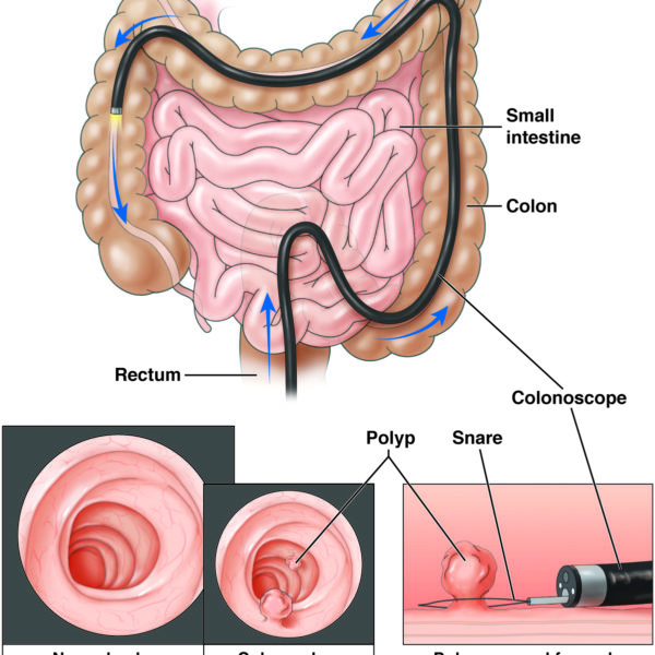 Colonoscopy