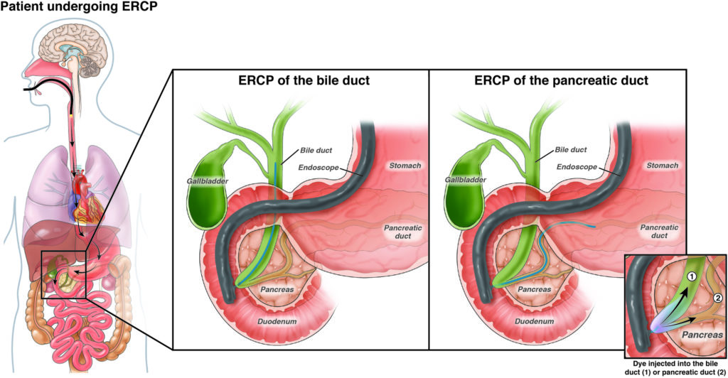 Patient undergoing ERCP
