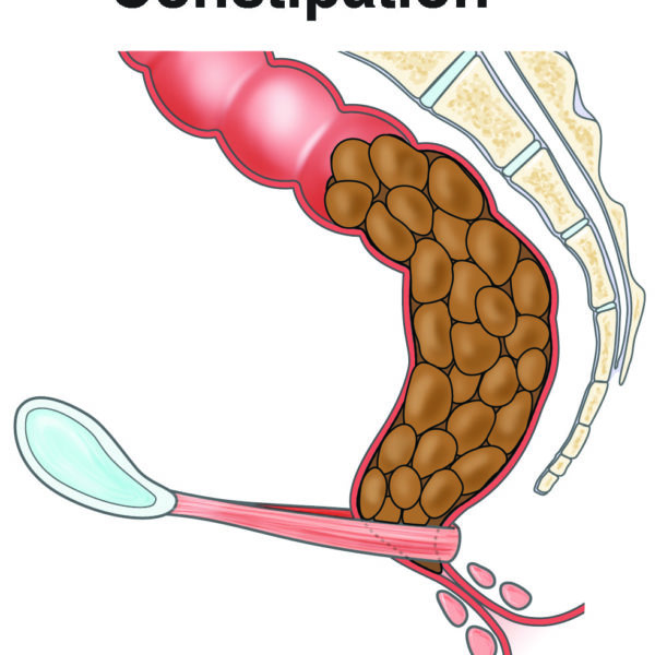 Constipation