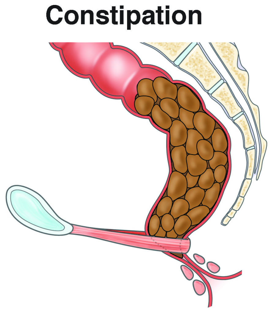 Constipation AGA GI Patient Center
