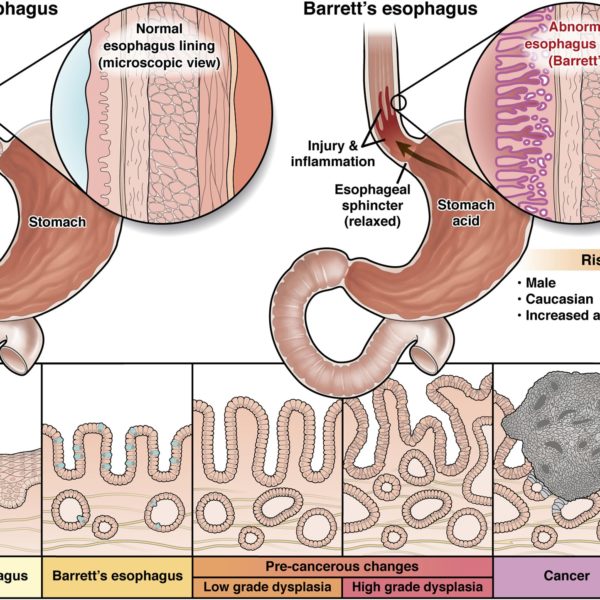 Normal esophagus and esophagus with Barrett's