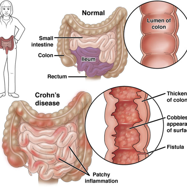 Normal colon vs colon with Crohns disease