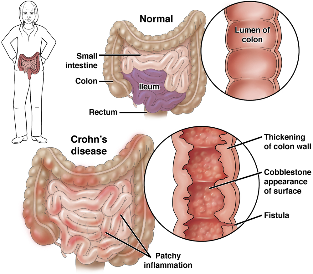 Crohn s Disease AGA GI Patient Center