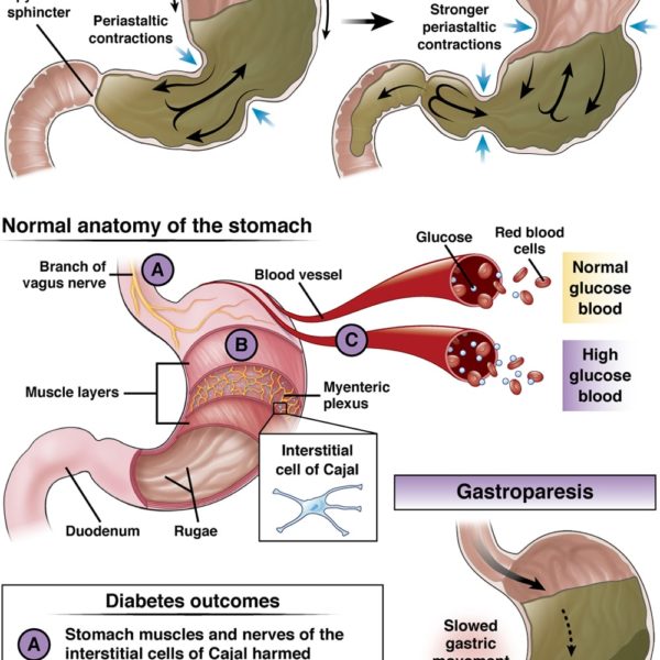 Normal gastric emptying vs gastroparesis