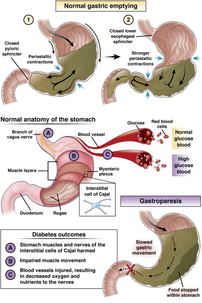 Normal gastric emptying vs gastroparesis