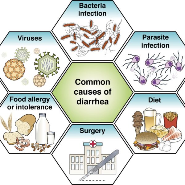 Common causes of diarrhea