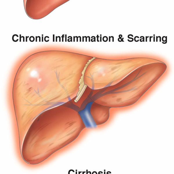 Normal liver vs liver with cirrhosis