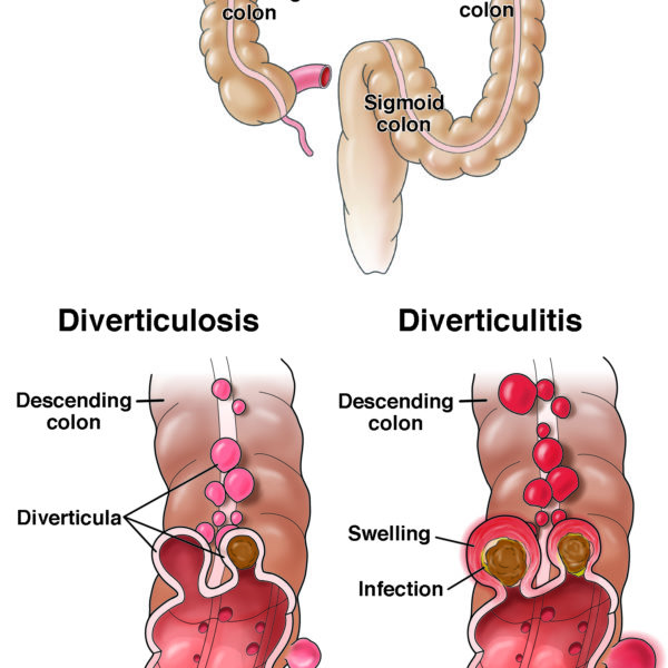 Normal colon vs colon with diverticulosis