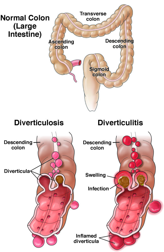 Normal colon vs colon with diverticulosis