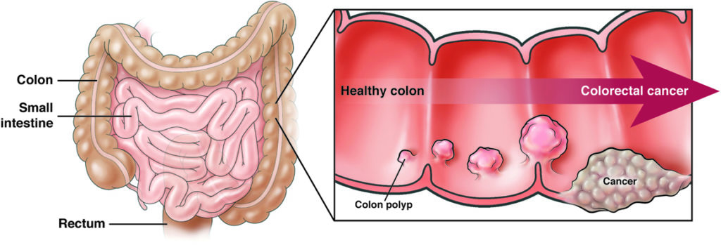 Healthy colon progression to colorectal cancer (CRC)