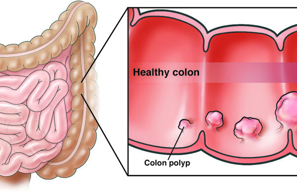 Healthy colon progression to colorectal cancer (CRC)