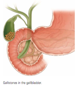 Gallstones in the gallbladder