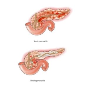 Acute and Chronic Pancreatitis