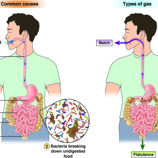 Common causes of gas