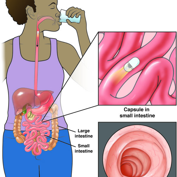 Capsule Endoscopy