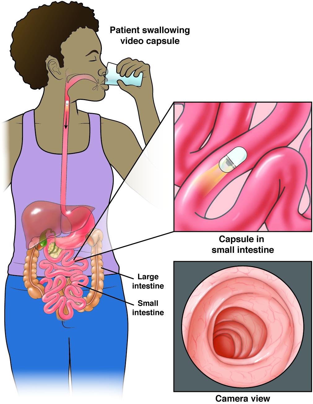 Capsule Endoscopy