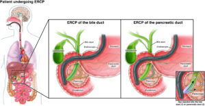 Endoscopic retrograde cholangiopancreatography (ERCP)