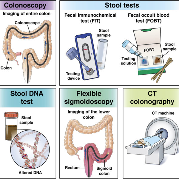 Colorectal cancer (CRC) screening options