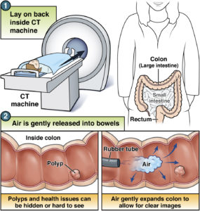 CT colonography