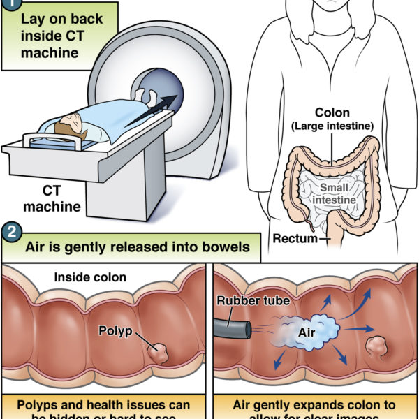 CT colonography