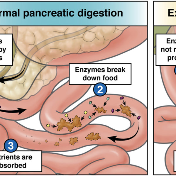 Exocrine pancreatic insufficiency (EPI)