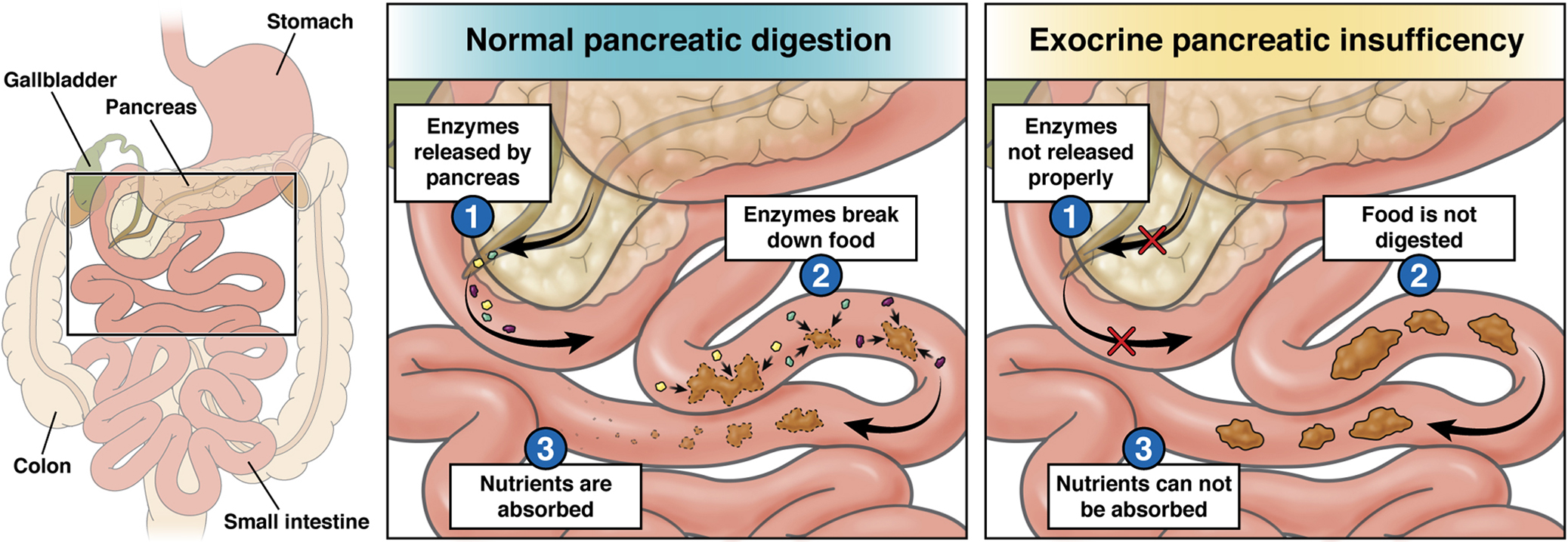 Exocrine Pancreatic Insufficiency EPI AGA GI Patient Center