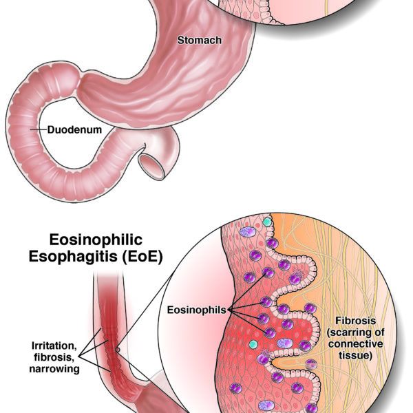 Eosinophilic esophagitis (EoE)