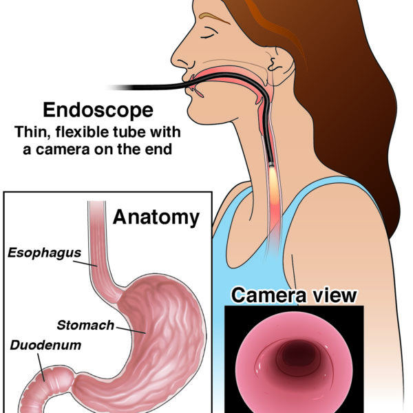 Upper GI Endoscopy