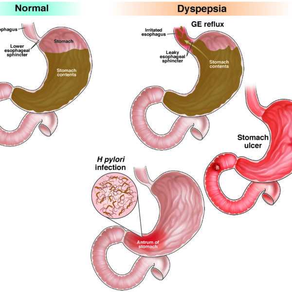 Dyspepsia