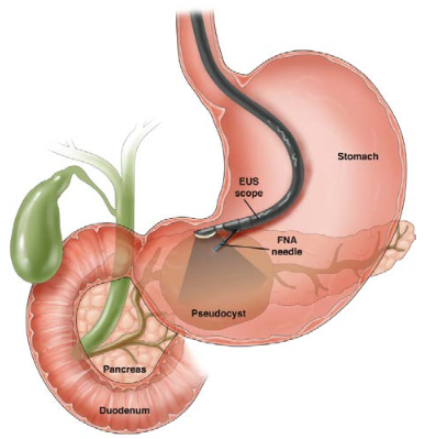 Endoscopic ultrasound (EUS)