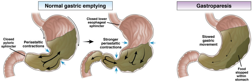 Gastric Emptying and Gastroparesis