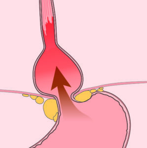 Gastroesophageal reflux disease (GERD)