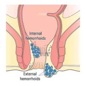 Hemorrhoids