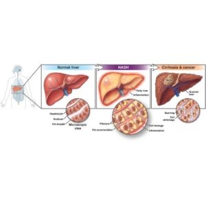 Liver NASH Cirrhosis