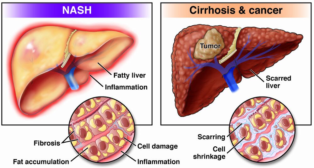 Liver with NASH, Cirrhosis and Cancer
