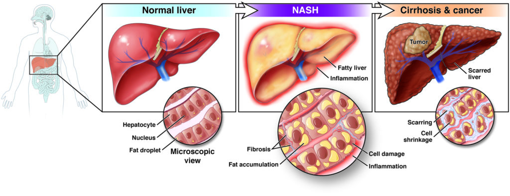Normal liver, NASH, Cirrhosis