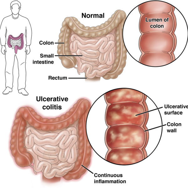 Ulcerative Colitis