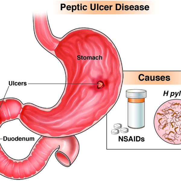 Peptic Ulcer Disease