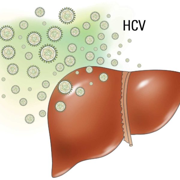 Liver with HCV