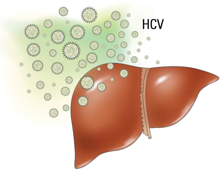 Liver with HCV