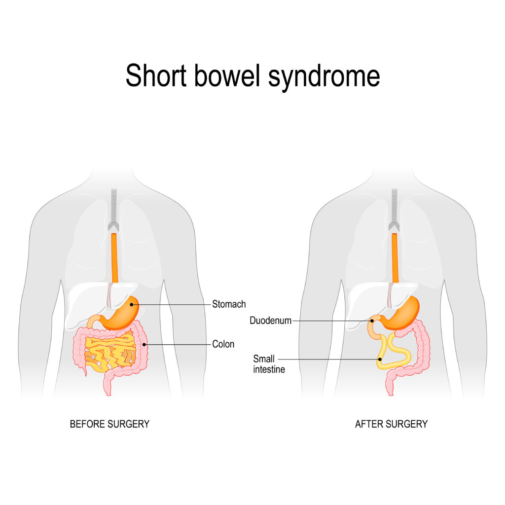 Short bowel syndrome image before and after surgery