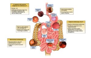 Iron deficiency anemia