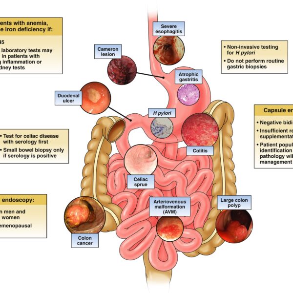 Iron deficiency anemia