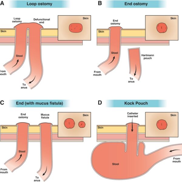 Graphic depicting a loop ostomy, end ostomy and other ostomy types.